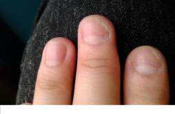 灰指甲是怎么形成的 灰指甲是怎么形成的有什么危害