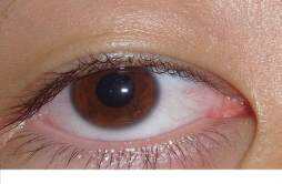 眼睛有红血丝是什么原因 眼球出血是什么原因引起的