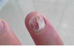 指甲脱落是什么原因 老人手指甲脱落是什么原因