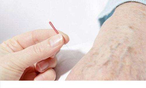 针灸可以治荨麻疹吗 荨麻疹针灸治疗方法