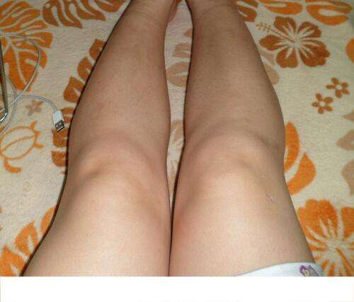 大腿溶脂针能保持多久 溶脂针瘦腿维持多久