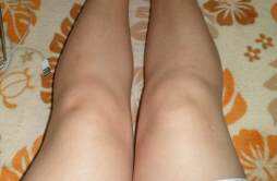 大腿溶脂针能保持多久 溶脂针瘦腿维持多久
