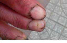 指甲裂开是什么原因 小拇指指甲裂开是什么原因