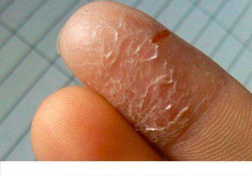 手指脱皮缺什么维生素 手指脱皮缺维生素B