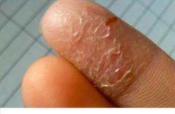 手指脱皮缺什么维生素 手指脱皮缺维生素B