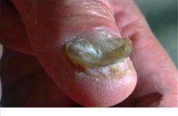 如何预防灰指甲 诱发灰指甲的原因