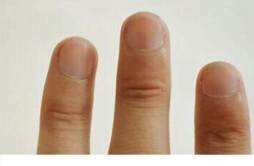 灰指甲早期症状 灰指甲的初期症状都有哪些
