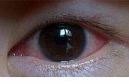 眼睛有红血丝是怎么回事 眼睛有红血丝有什么对策