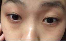 眼睛下面长斑是怎么原因 眼睛下面长斑是什么原因导致的