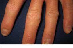 灰指甲有哪些类型 灰指甲是哪一种