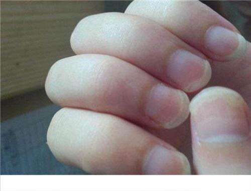 灰指甲传染吗 容易感染灰指甲的人群