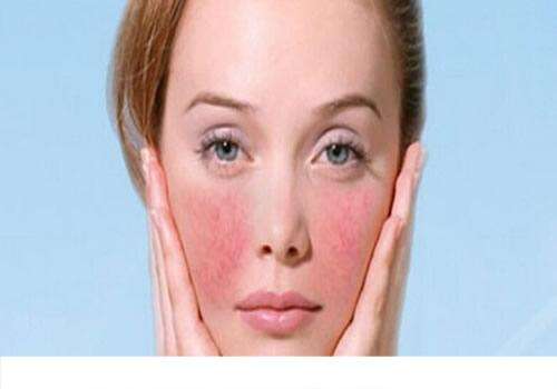 脸上有红血丝是敏感肌肤吗 红血丝敏感肌肤的保养方法