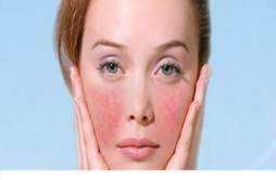 脸上有红血丝是敏感肌肤吗 红血丝敏感肌肤的保养方法
