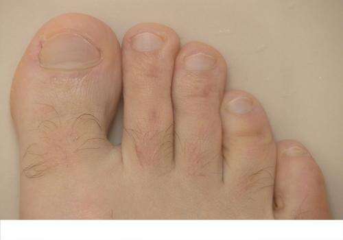 脚趾甲有一个变厚凸起 灰指甲的治疗方法