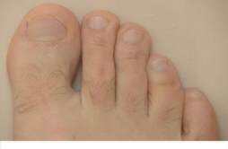 脚趾甲有一个变厚凸起 灰指甲的治疗方法