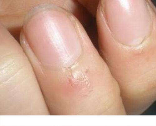 指甲周围长倒刺是缺维生素吗 指甲周围长倒刺是缺维生素吗蚂蚁庄园