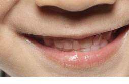 嘴巴动手术会留疤吗 如何避免嘴巴动手术不留疤