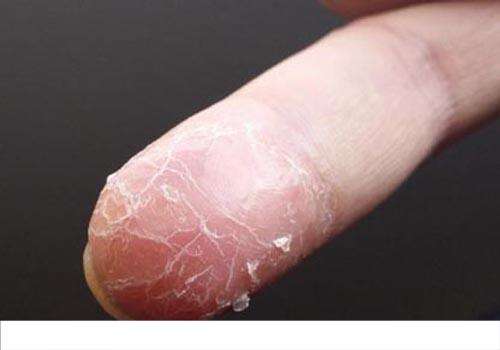 手指脱皮快速恢复方法 手指脱皮快速恢复方法有哪些