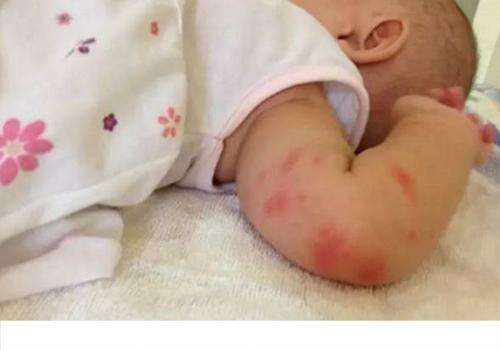 宝宝被蚊子叮了有疤自己会消吗 宝宝被蚊子咬怎么去疤