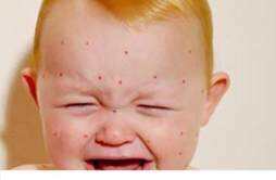 水痘的症状和治疗 九岁孩子起水痘的症状和治疗